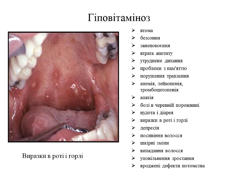 Гіповітаміноз  втома безсоння занепокоєння втрата апетиту утруднене дихання проблеми з пам'яттю порушення травлення